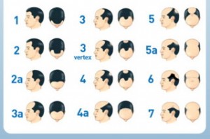 saç dökülme tipleri